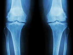 დაზიანებული სახსრები